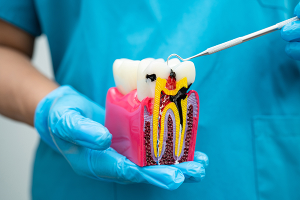 Common Reasons For Root Canal Therapy